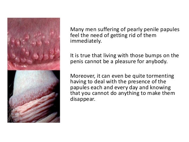 Little White Bumps Around Head Of Penis Little White Bumps Around Head Of Penis